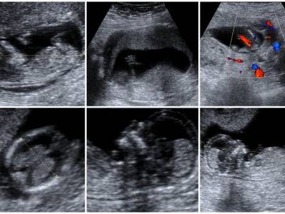 FETAL ECHO CARDIOGRAPHY